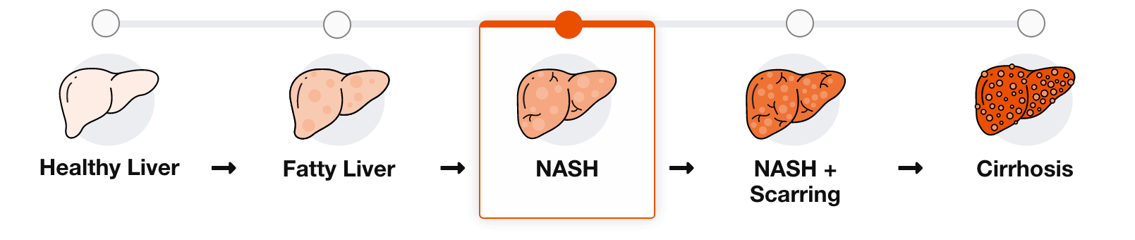 NASH: Toxic Fat Buildup and Inflammation
